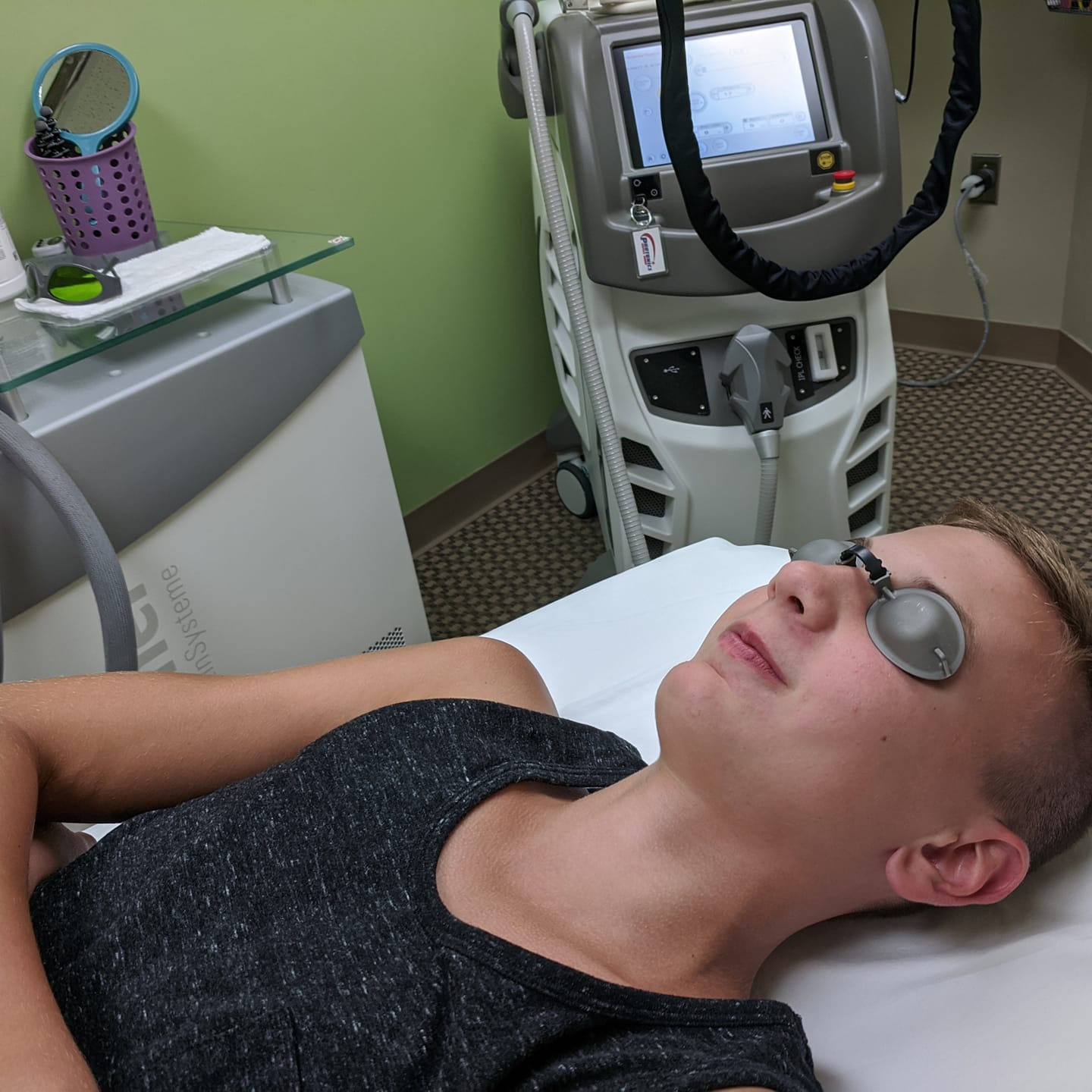 Laser acne reduction treatment