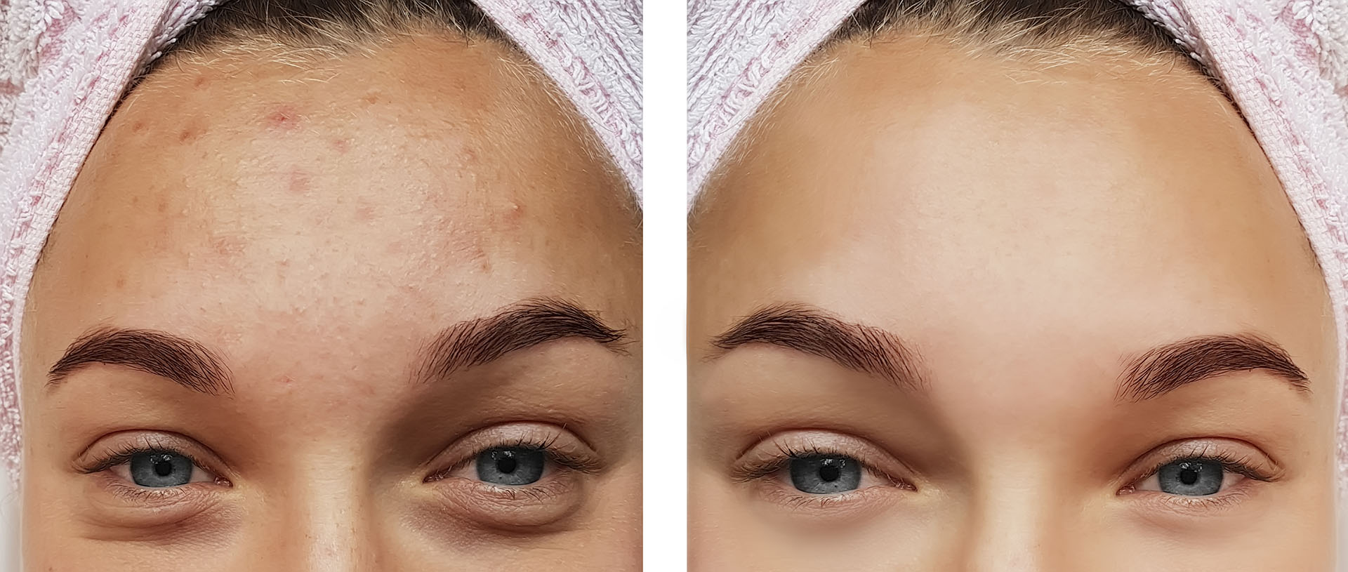 Acne Reduction