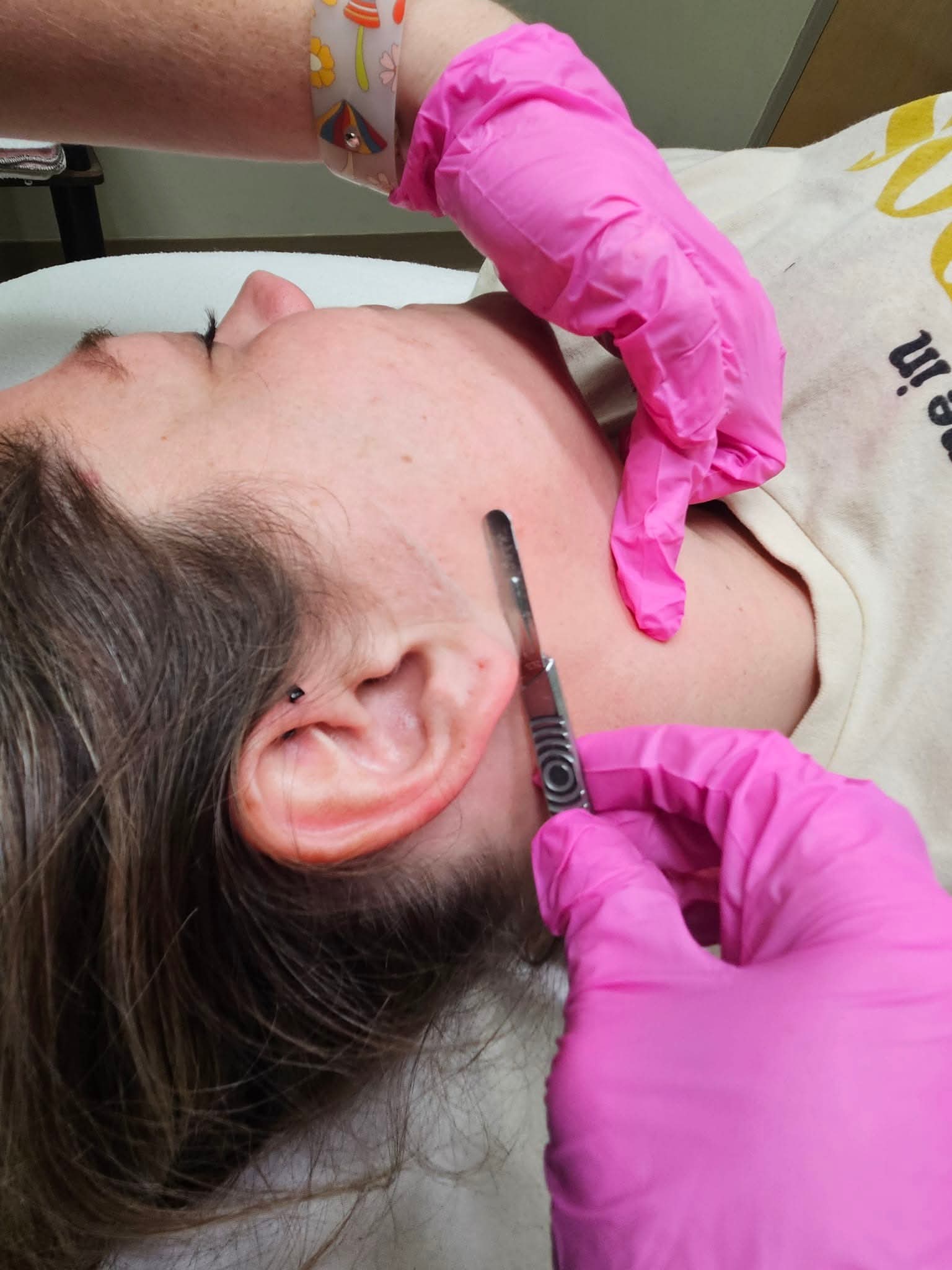 Dermaplaning treatment