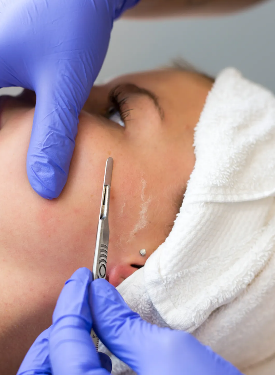 Dermaplaning