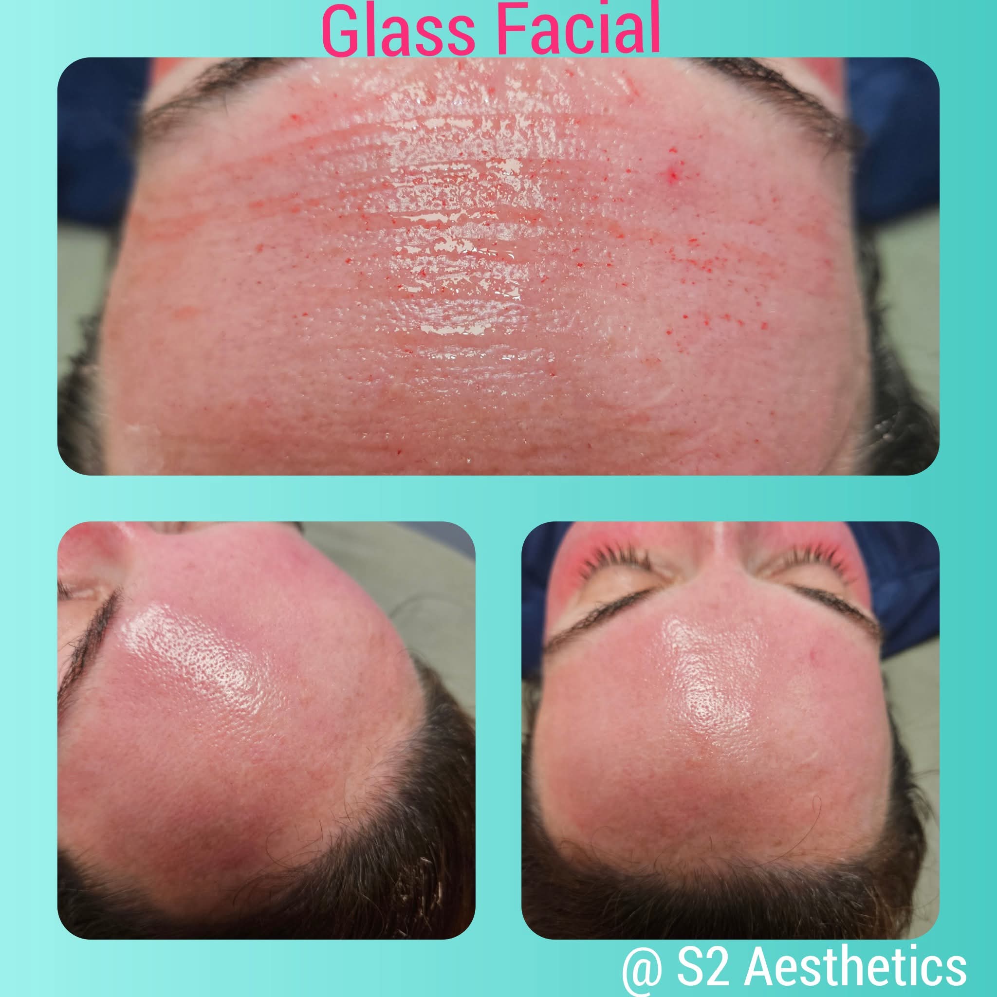 S2 Glass Facial