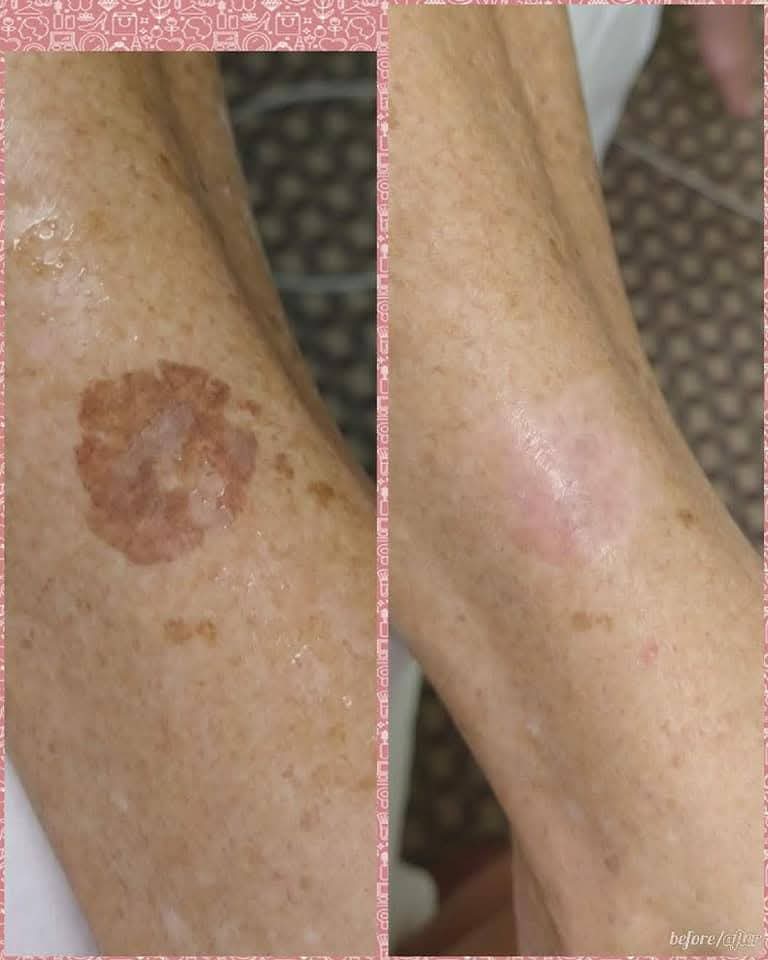 Client receiving IPL photofacial treatment