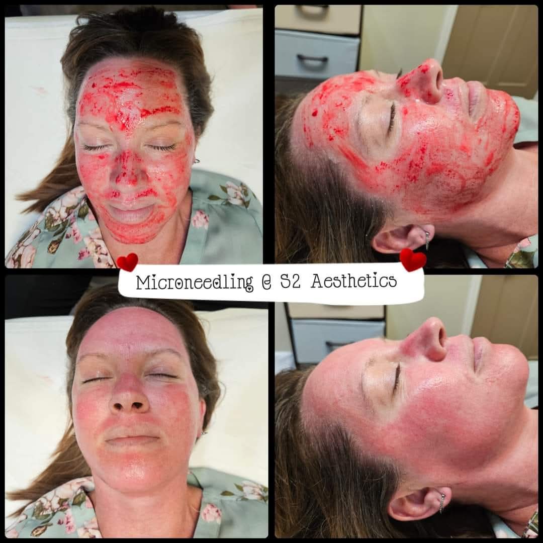 Microneedling