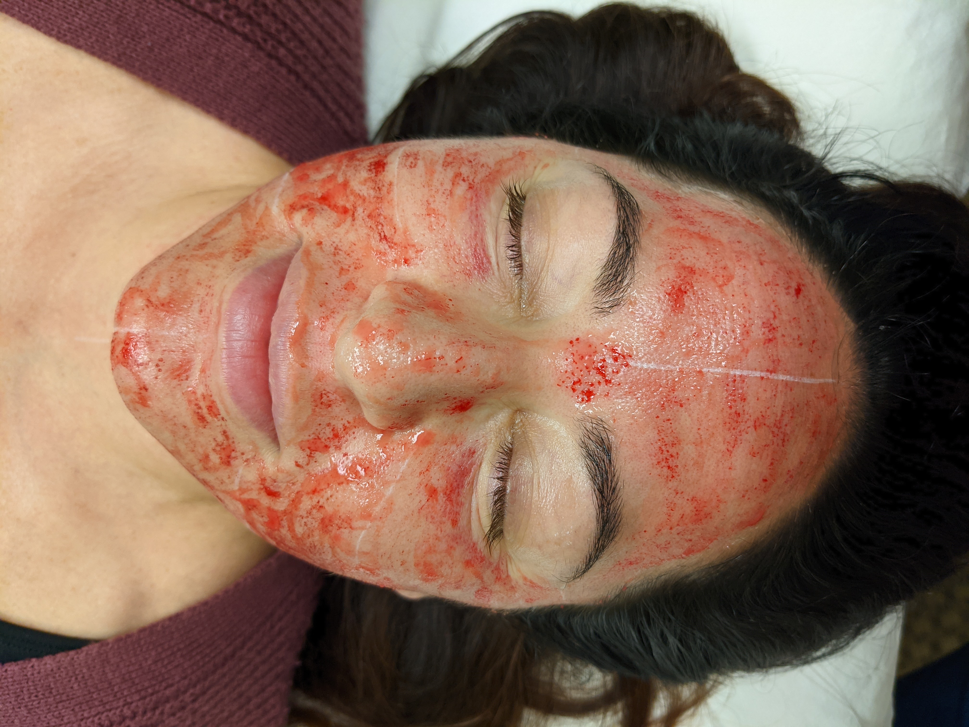 Microneedling treatment
