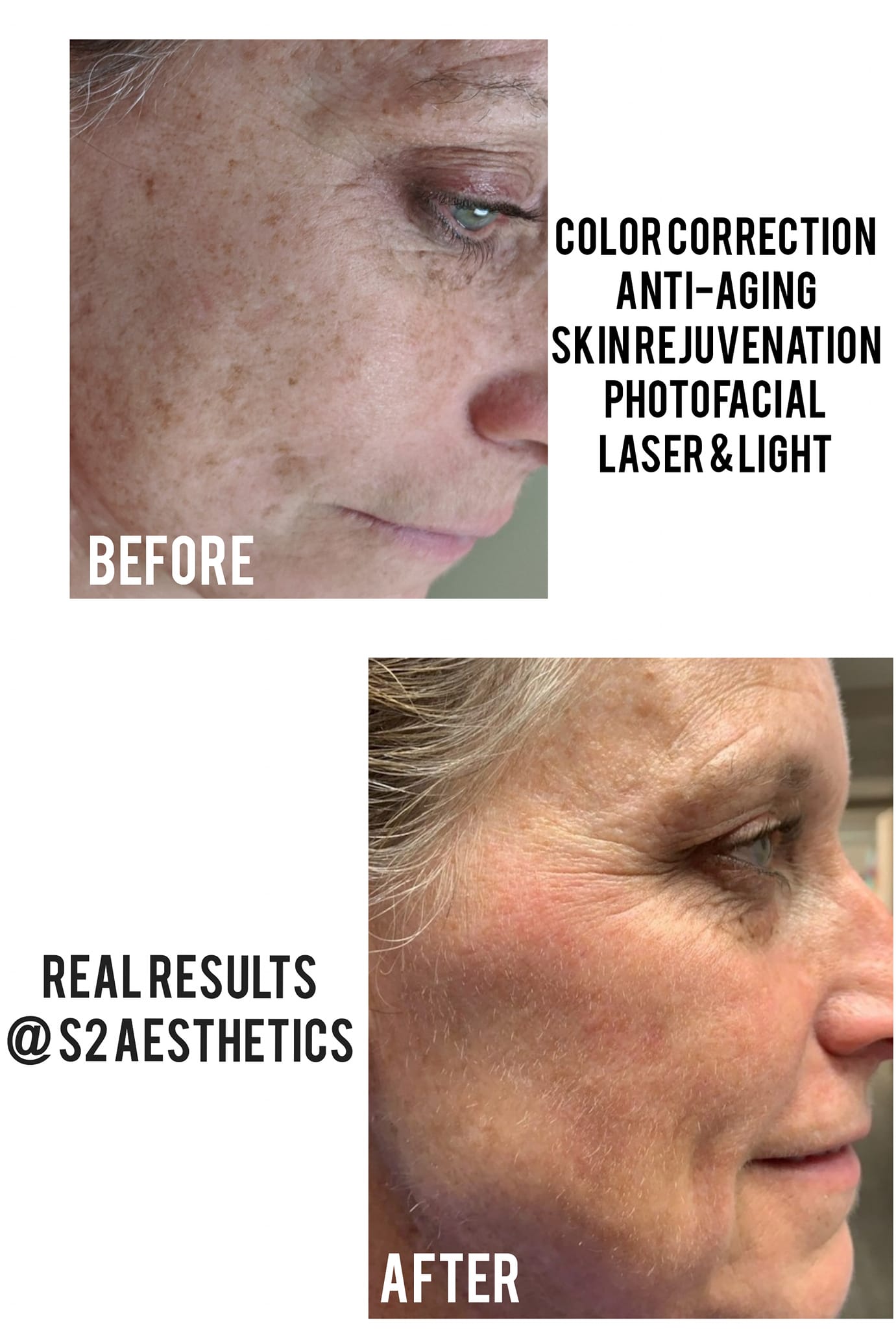 Photofacial Skin Rejuvenation