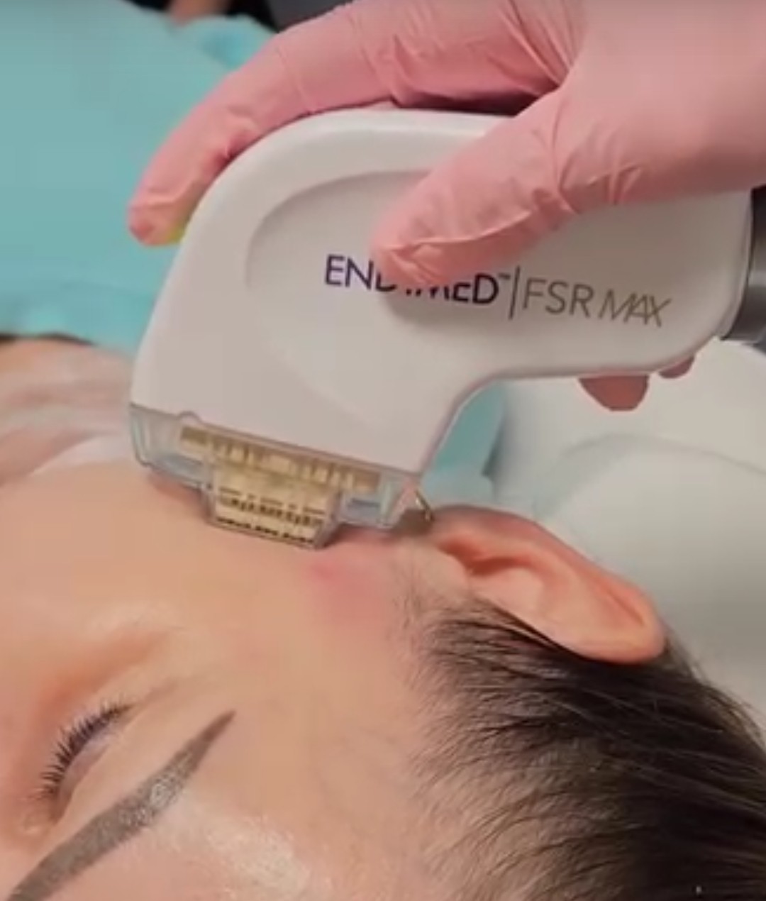 RF Skin Resurfacing