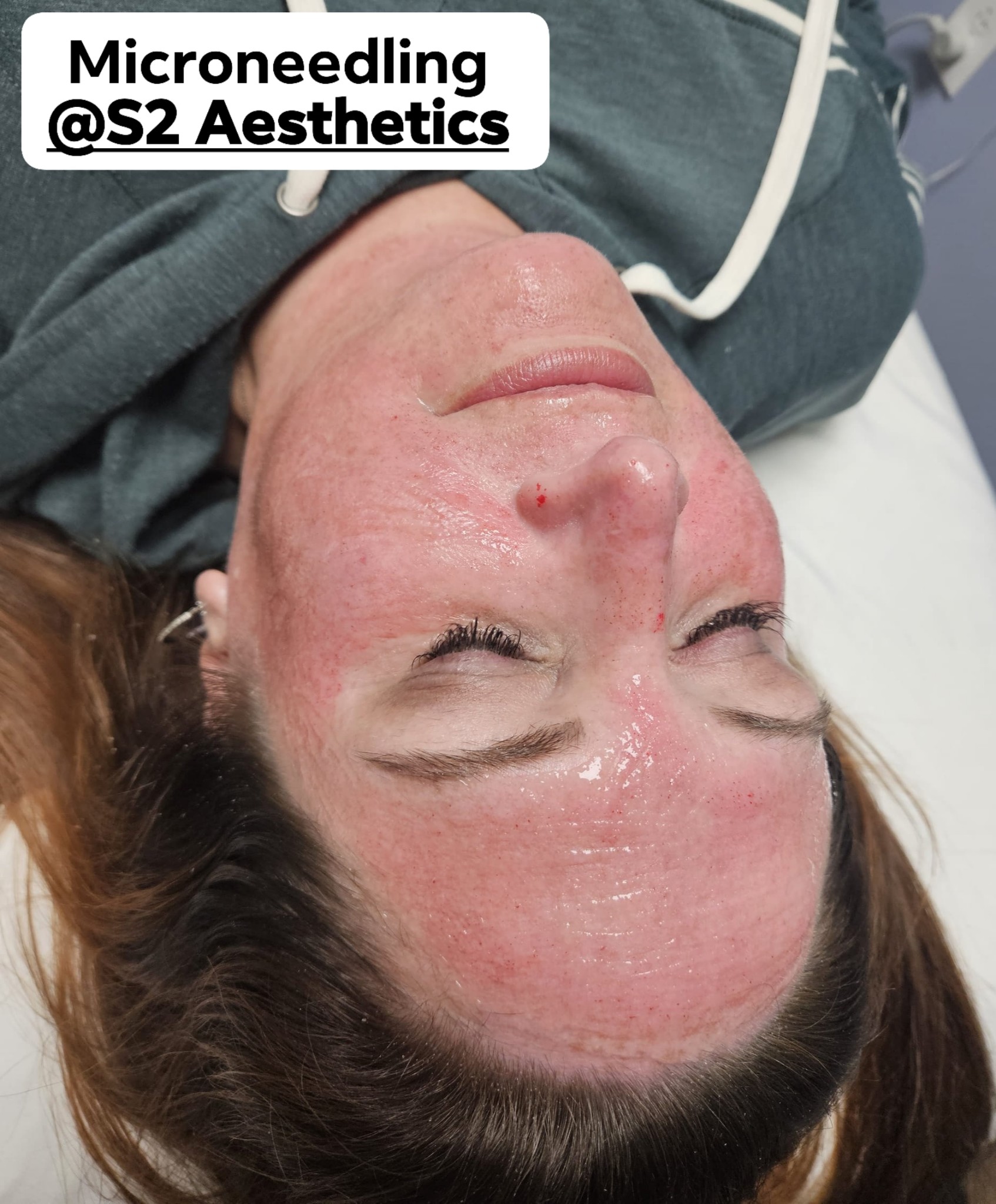 RF Microneedling treatment