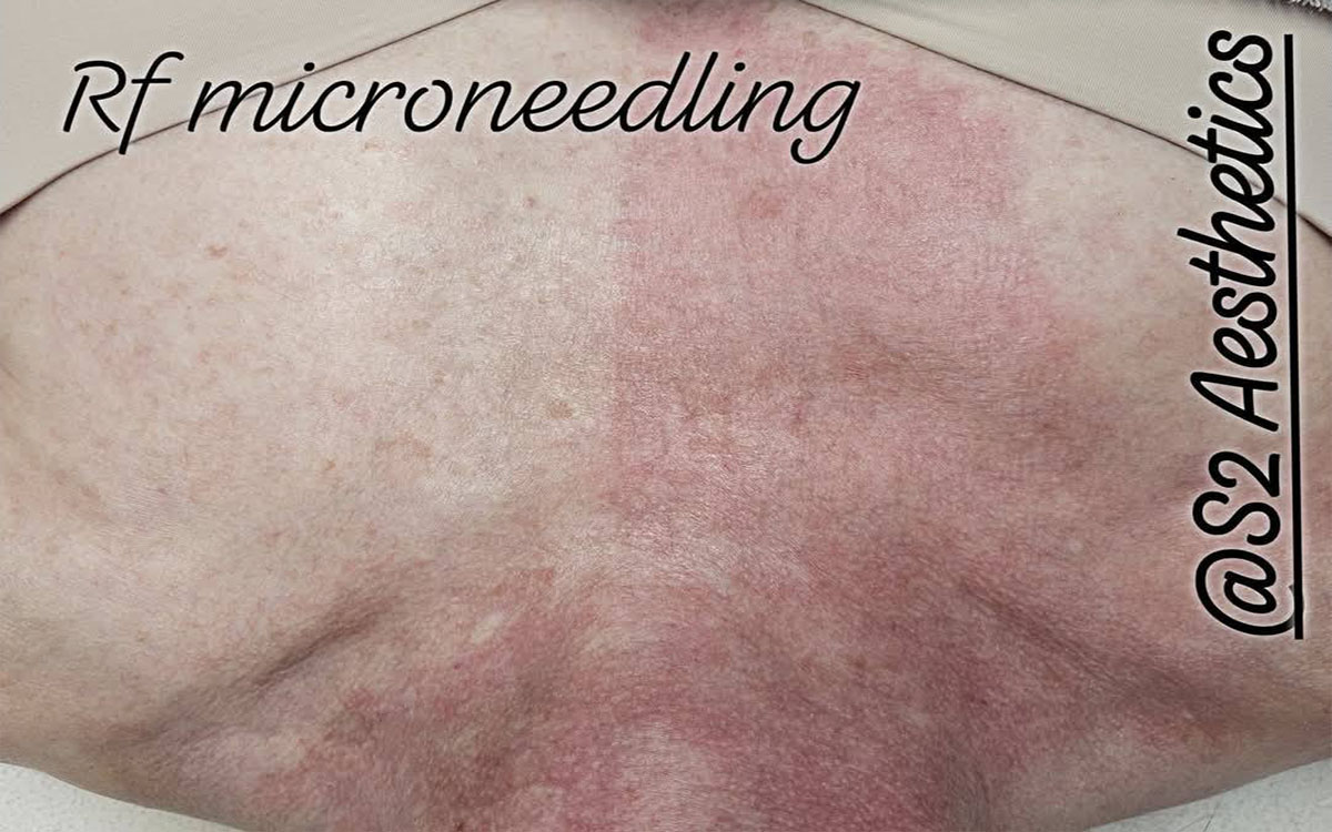 RF Microneedling