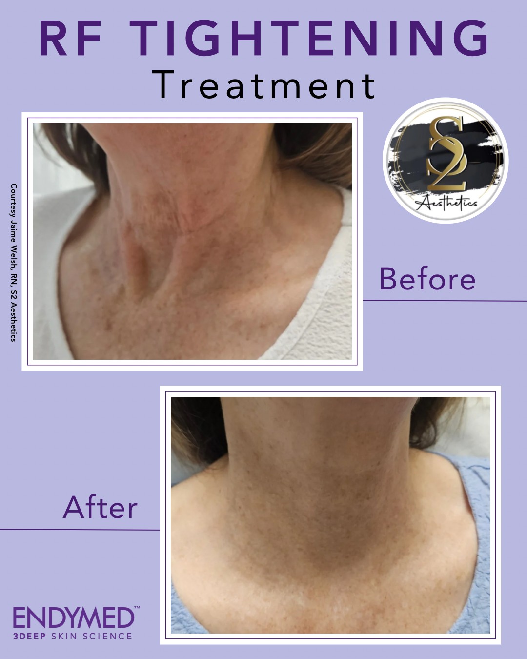 Radiofrequency skin tightening treatment