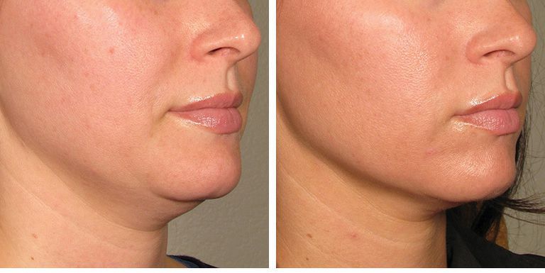 Non-Ablative Laser Facial