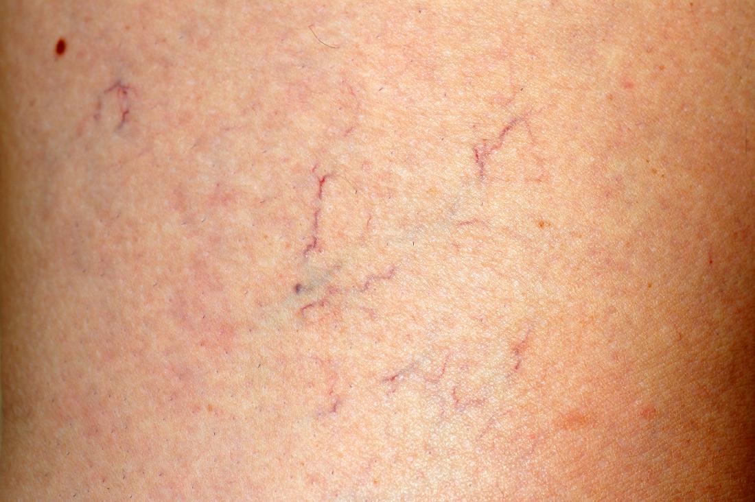 Laser vein treatment of spider veins