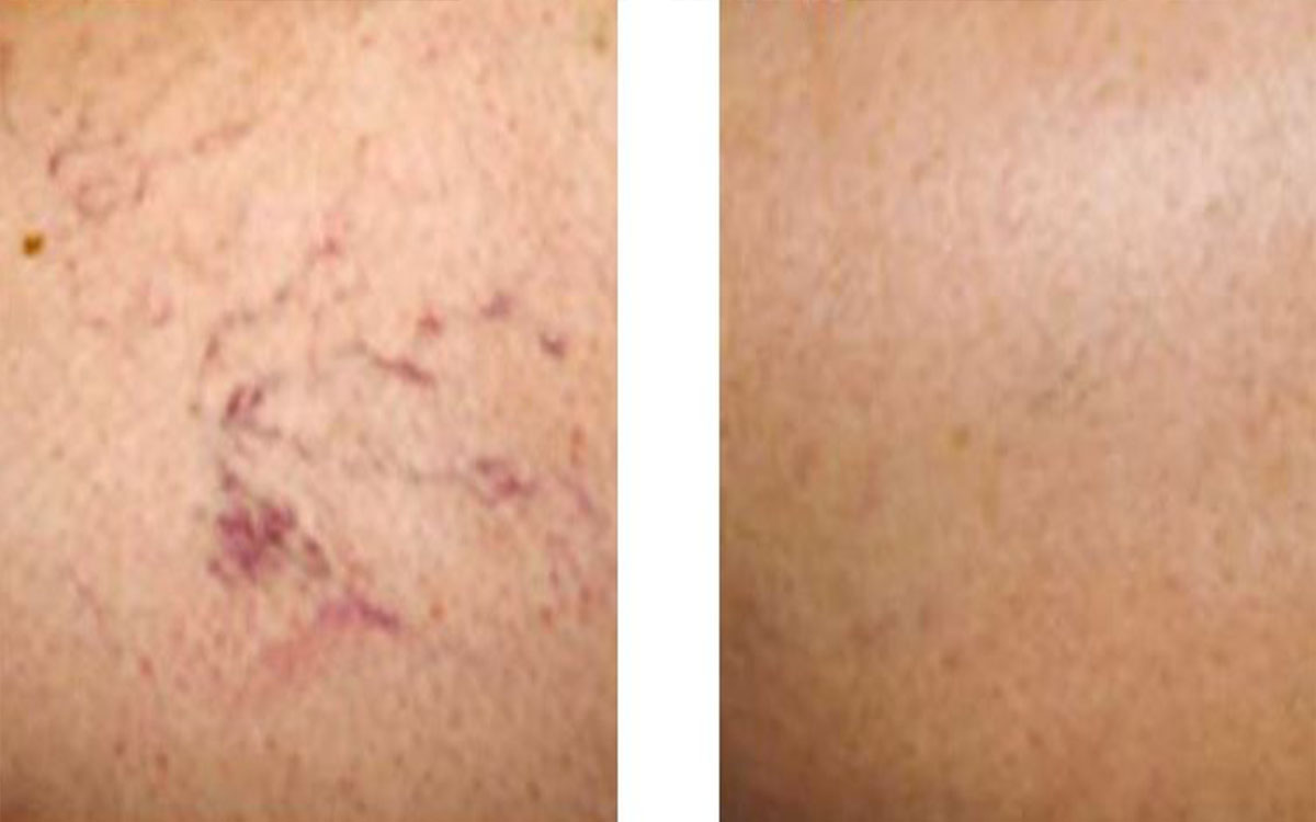 Vascular Laser