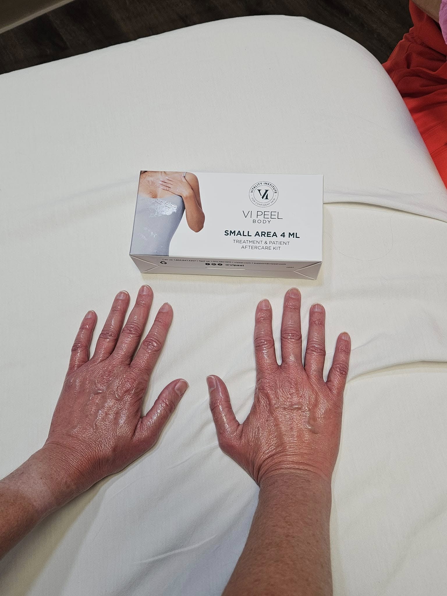 VI Peel treatment