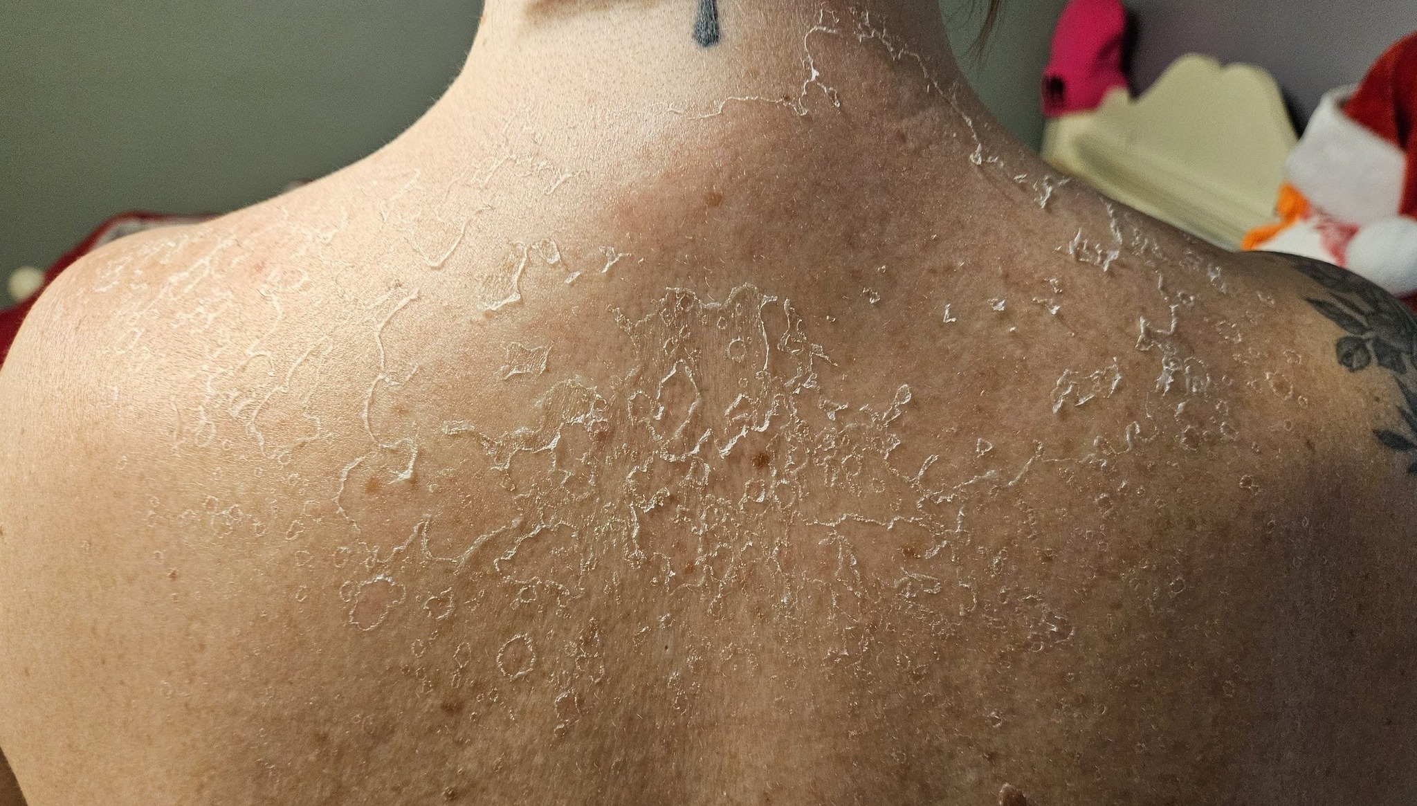 Chemical peel concept