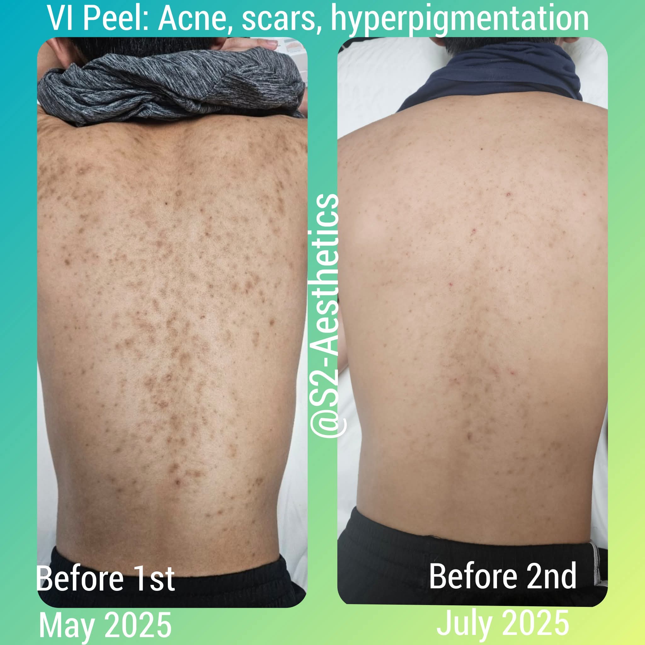 VI Peel